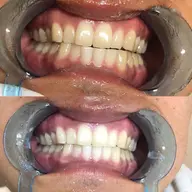 🦷🍀ミニモ限定10名様まで🦷🍀2来店合計80分¥20000円→¥12000円⭕️🌈真っ白コース🌈