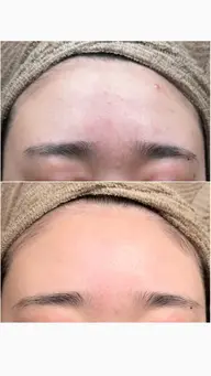 最新プラズマ⚡️フェイシャル