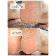 ⭐️フット角質取り-素足美人コース⭐️