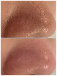 ハイドロスプラッシュ/Tゾーンポイントケア