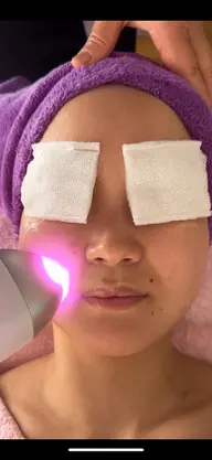 最新LED脱毛 鼻の産毛だけ脱毛したい方に朗報❗体験爆安ミニモキャンペーン