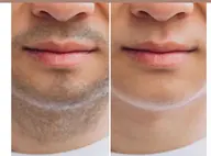 メンズ脱毛 最新LED脱毛*お顔のパックつき