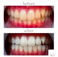 1番人気❤️VIPホワイトニング20分×２回🦷🫧¥7,980▶︎¥4,980💖