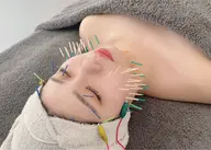 【限定価格💕】100本美容鍼5,900円(税込)