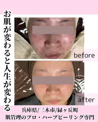 本気のハーブピーリング選べる(剥離あり、なし)肌質改善Ｎｏ．1