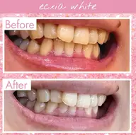 【平日限定/16時まで】セルフホワイトニング（9分×2セット）1回 ¥500