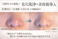 毛穴集中ケア　大好評につきモニター様募集【本気でお肌を改善したいと思っている方限定】