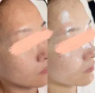 【圧倒的人気No.1✨】ララピールの進化版、乳酸菌配合セラピール+美白IPLフォト+セラパック