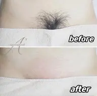 【U24学割 3月末まで】VIOダブル脱毛+3箇所光脱毛（シュガーリング×光脱毛＝ダブル脱毛）