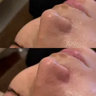 無料体験✨毛穴ゴッソリ洗浄🫧（詳細確認必須）