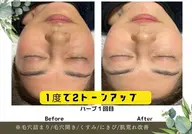 【まずはお試し】剥離なしハーブピーリング🌿ニキビ/毛穴/ニキビ跡※鎮静栄養パック付¥19800→特別価格¥15,000