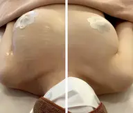 バスト左右差、下垂、