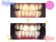 継続率90%‼️【ご新規様限定💄】《セルフホワイトニング》韓国美白ホワイトニング[岡山市北区柳町・中央町]