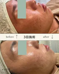 【モニター】ニキビ、ニキビ跡専用エステ