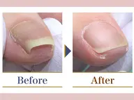 【巻き爪1箇所】痛みがある方！痛みがなくても巻きが強い方！！専用の器具で優しく、効果的な施術をいたします。