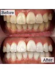 【💛早さ×効果に自信あり💛】5分照射×4回🦷通常の約2倍の照射パワーで即効性⭕️ハイパワーセルフホワイトニング🔥