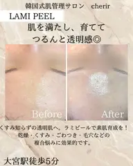 【平日限定】人気No,1❣️韓国艶肌ラミネーションピーリング💎➕毛穴洗浄✨➕鎮静パック🫧