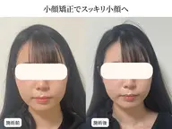 【エラ張り・むくみ改善】小顔整体+4D小顔矯正+姿勢矯正 12000円→