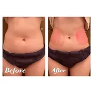 【1箇所】❄️-12℃冷却痩身❄️