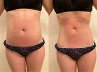 【人気No. 1】冷却1箇所+次世代EMS