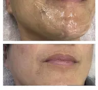 お試しメンズ髭脱毛