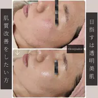 【ミニモ限定モニター募集】ハーブピーリング3回券