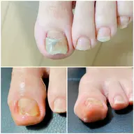 トラブル爪ケア(爪の変色・分厚くなる爪・伸びない爪)1本※別途リケアオイル3630円
