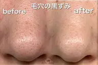 🔷メンズ美顔🔷【アクネ菌ケア シミたるみ改善 毛穴黒ずみ】本気で美肌を目指す男性 肌の内側から美しく線維芽細胞増殖!