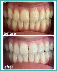 2日間限定！ホワイトニング🦷ミニモ限定価格‼️当店人気No.1コース👑20回コース(現金払いのみ)