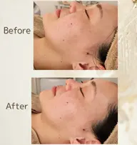 【初回】ツヤ肌フェイスシェービング