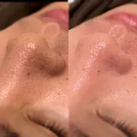 ミニモ学割🌸U24【メンズOK◎】黒ずみ毛穴洗浄+保湿ケア✨