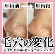 毛穴ケア【スペシャル】デコルテ付