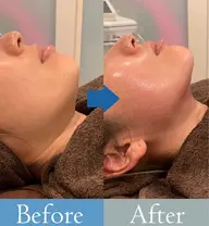 Facial【驚くほどの小顔✨ミニモ限定🉐】驚くほどの小顔❣️フェイシャル4000shot＋美顔器＋軽いマッサージ