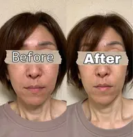 痩身マシン　2500shot