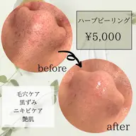 【時短!ピーリングでつるんとモテ肌🤍】敏感肌もOK!ハーブピーリングor保湿ピーリング🌿¥11000→¥5500