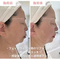 卒業式・入学式前限定🌸写真に残る“ママのためのリフトアップケア”