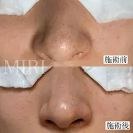 初めての方向け🔰【毛穴ベーシックコース70分】初回カウンセリング込100分