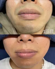 今日限定🫧ヒゲ脱毛¥550