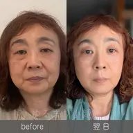 ほうれい線卒業♡口紅の映える口元に【 頭蓋骨調整＋ほうれい線フェイシャル＋頭蓋骨ケア】65分 半額の6500円