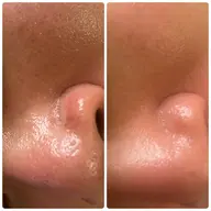 【 夕方割 】 電気美容鍼➕アロマヘッドマッサージ