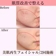 【美肌再生フェイシャル】ハリ潤いのある若々しい素肌へ♪繰り返す肌悩み/肌質改善/デコルテ付き《初回限定💫特別価格》