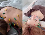 【お得な濃厚プラン】100本美容鍼×首肩こり集中！