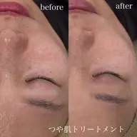 【速攻美肌】つや肌トリートメント