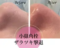 【新規】毛穴/黒ずみ/詰まり/ざらつき/テカリ/開き　憧れタマゴ肌を実感！