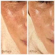 【NEW即効性最強ピーリング】水光ピール+毛穴洗浄&血流リンパマッサージ+美容液導入 70分