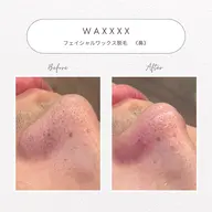 パーツワックス脱毛《鼻》