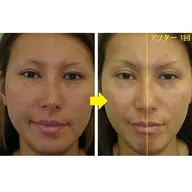 【非対称な顔歪み/下顎,エラ,頬の専門矯正+重心バランス調整】上級MAXコース￥9,980現金限定