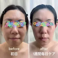 【小顔補正/頭皮マッサージ/バブルパック】ヒト幹細胞！浮腫みたるみ改善９０分