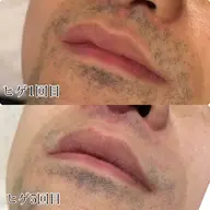 men'sヒゲ脱毛1回