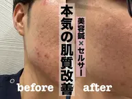 【紫外線対策】美容鍼灸+セルサーうるツヤ美肌へ(美肌ケア・ニキビ・毛穴)